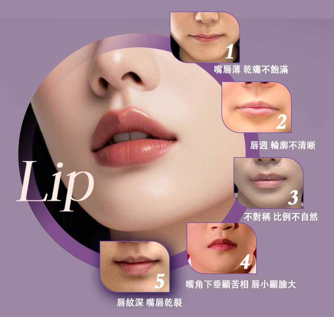玻尿酸豐唇唇形01